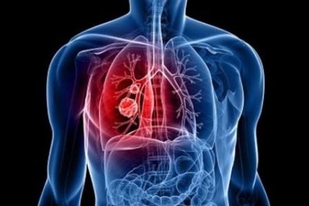 Չծխողների մոտ թոքերի քաղցկեղի երեք նոր ենթատեսակ են հայտնաբերել