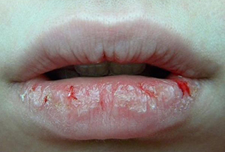Ինչպե՞ս բուժել ճաքճքած շուրթերը