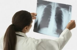 Թոքի քաղցկեղ․ տարածված միֆեր և իրականություն