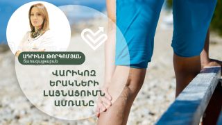 Վարիկոզ երակների լայնացումը՝ ամռանը