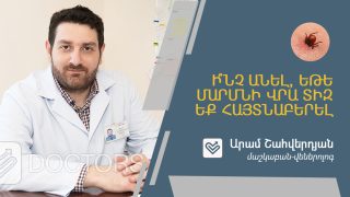 Ի՞նչ անել, եթե  մաշկի վրա տիզ եք հայտնաբերել