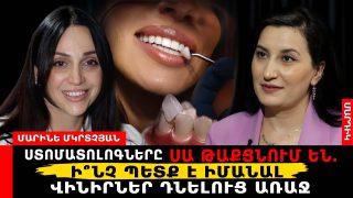 Ստոմատոլոգները սա թաքցնում են. Ի՞նչ պետք է իմանալ վինիրներ դնելուց առաջ
